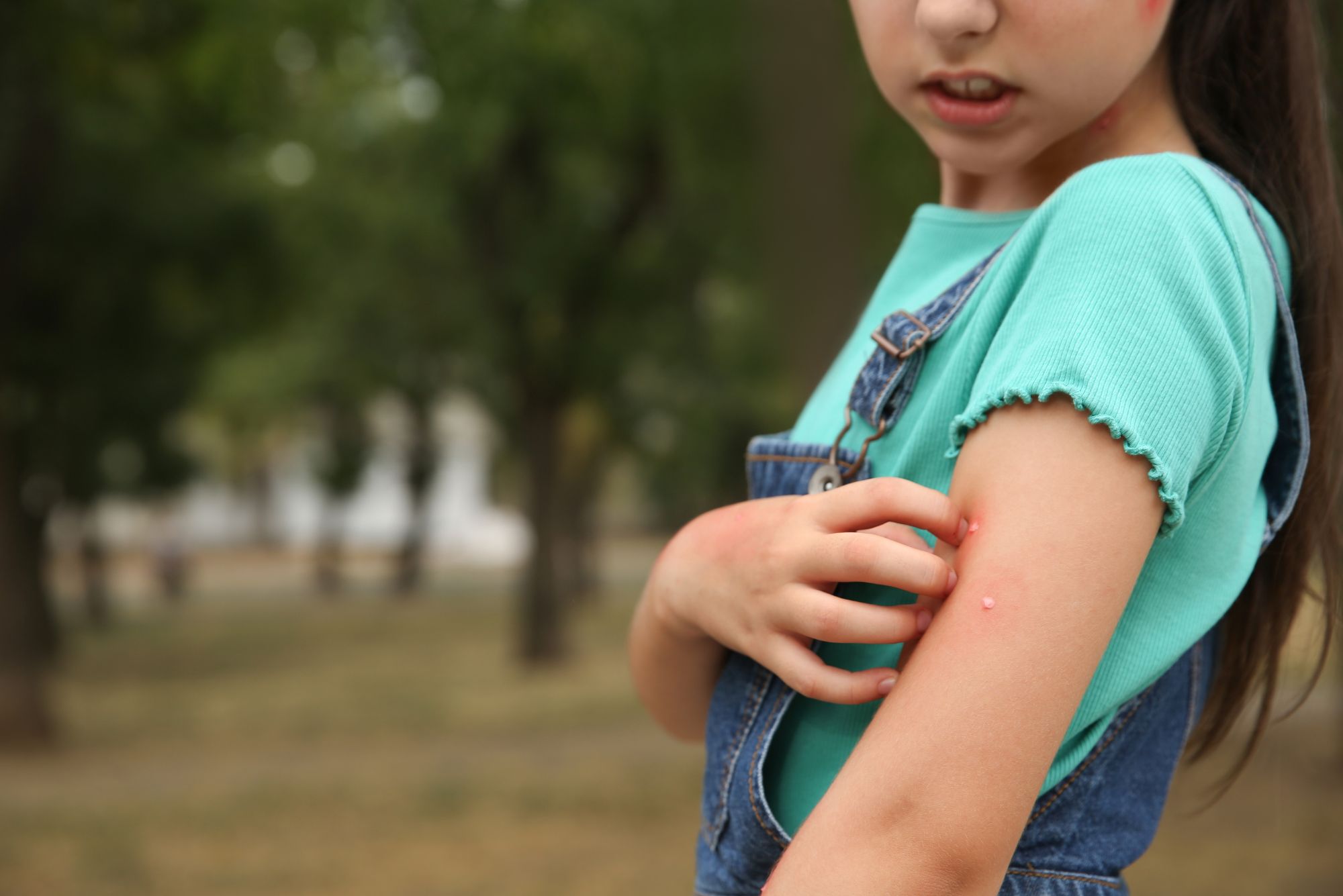 A girl in Florida itches her mosquito and bug bites.