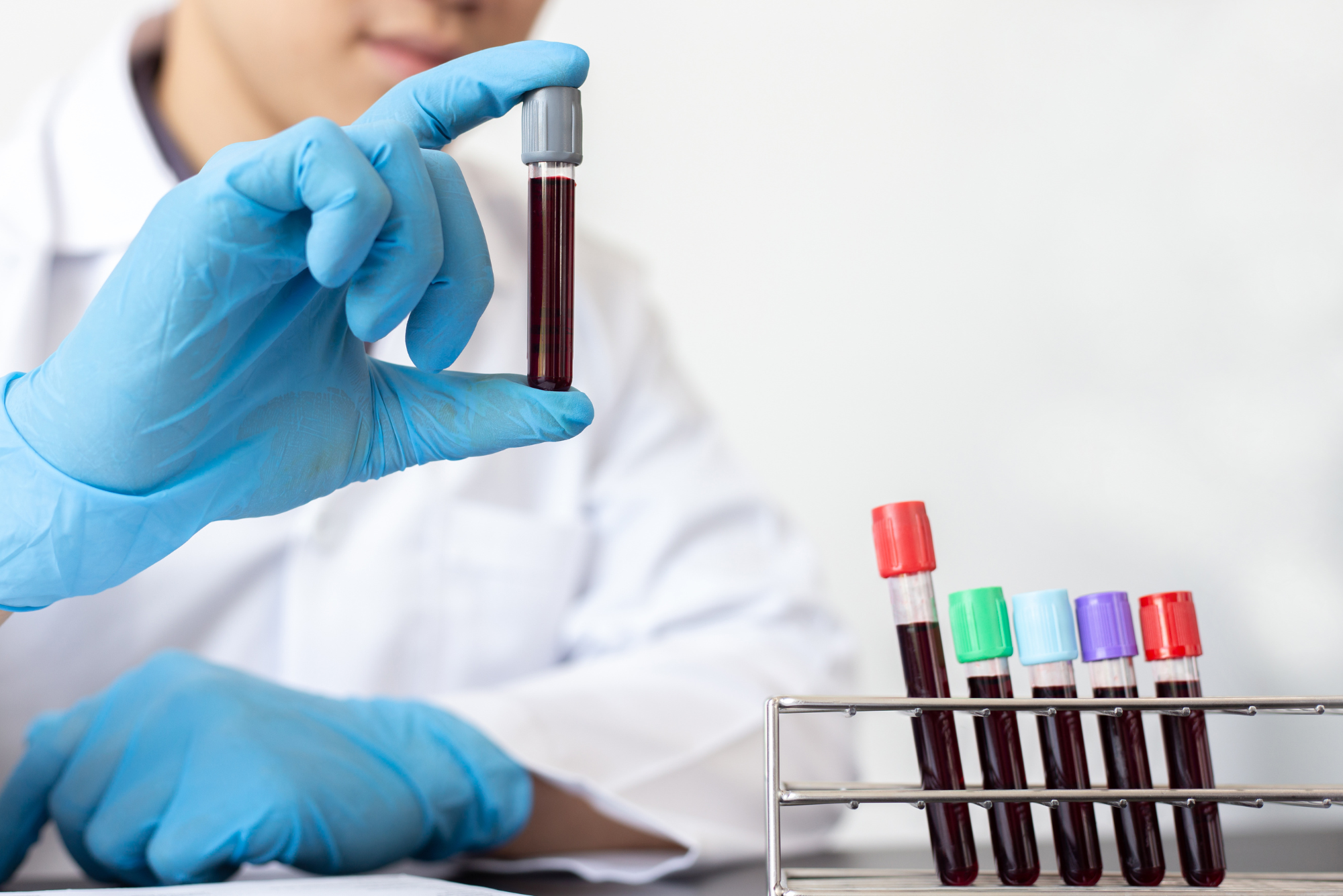 A lab tech holds up a vial of blood from a patient, representing a discussion on how to prepare for a blood test.