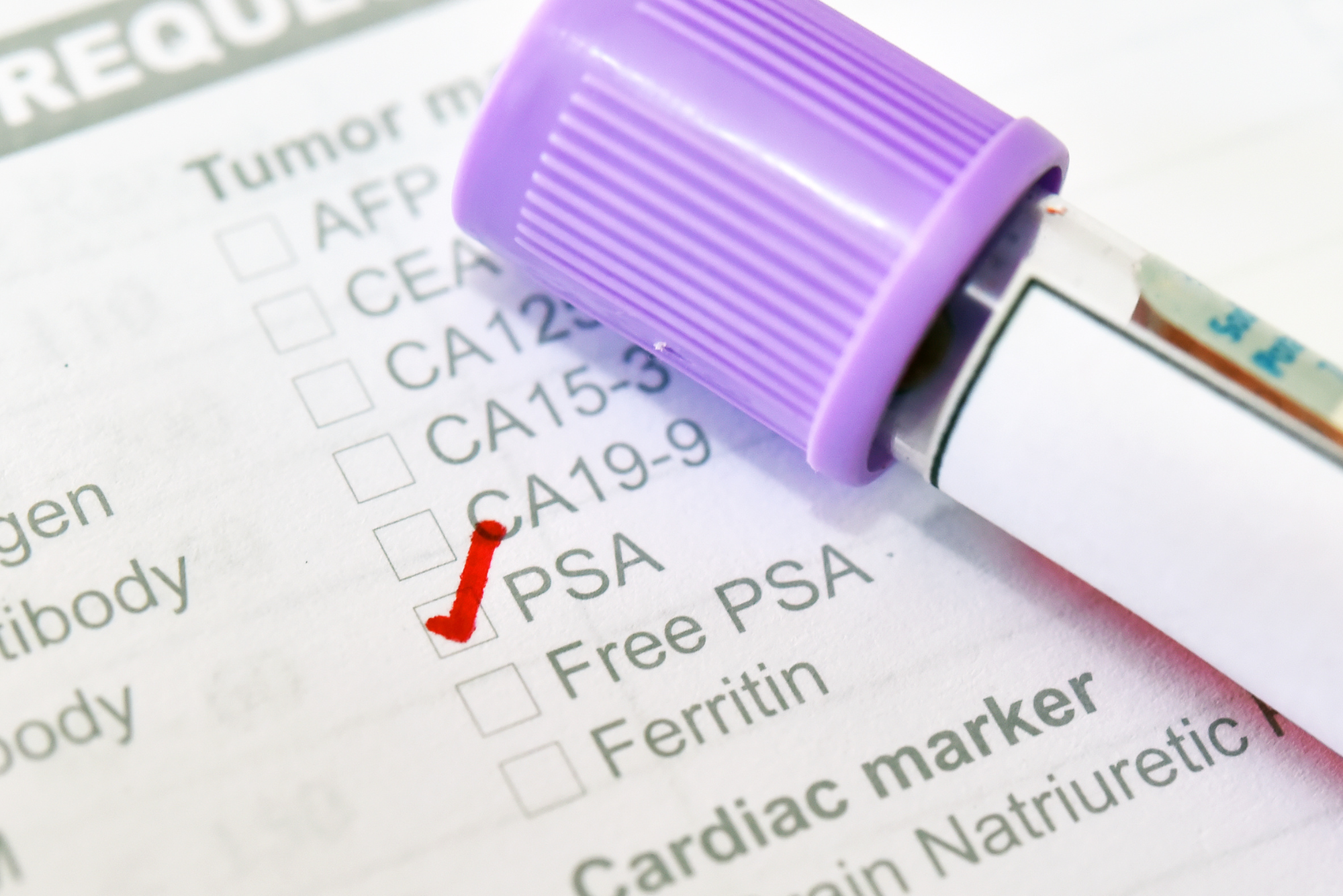 A vial of blood from a blood test lies on an order sheet with the box for a PSA test checked.