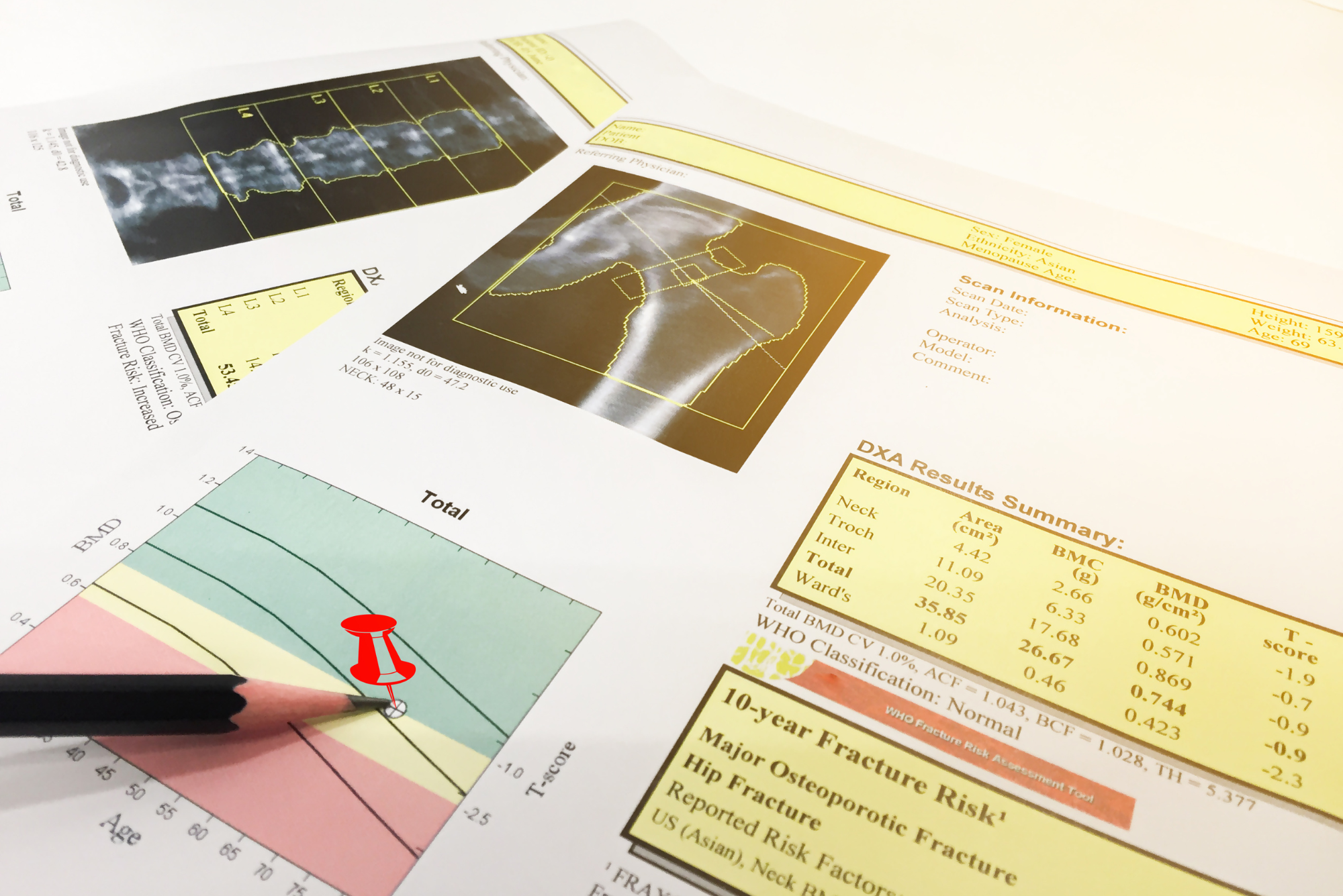 Results from a bone density test lay on a table, showing what they can detect.